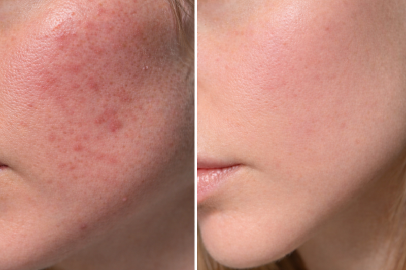 Hudvårdsresultat före och efter