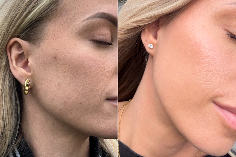 Hudvårdsresultat före och efter