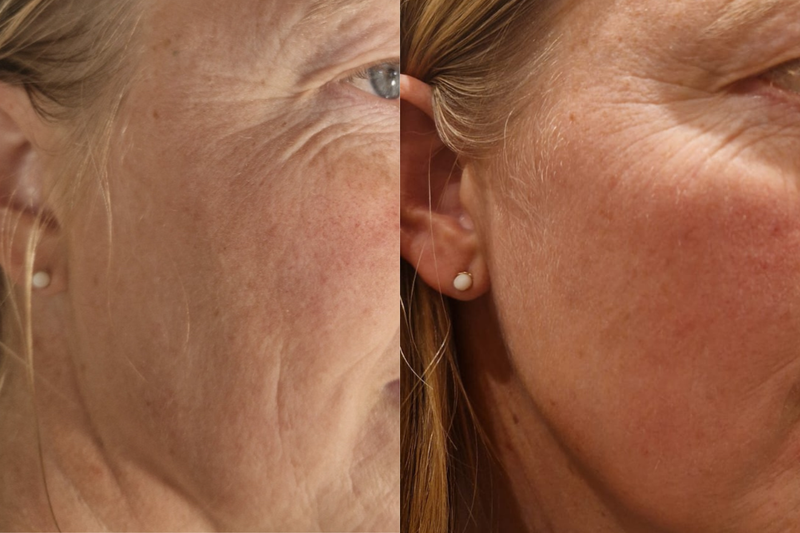 Hudvårdsresultat före och efter