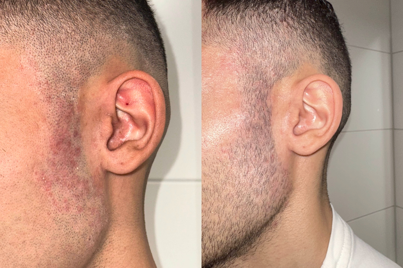 Hudvårdsresultat före och efter