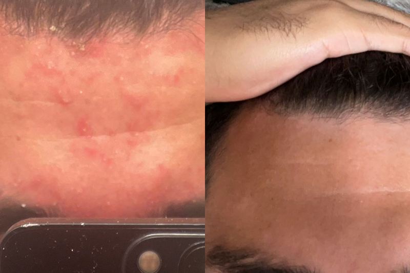 Hudvårdsresultat före och efter
